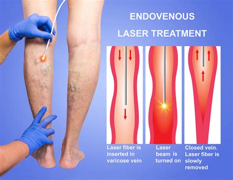 Varicose Veins | Spider Veins Treatment in Ulhas Nagar | Surekha ...