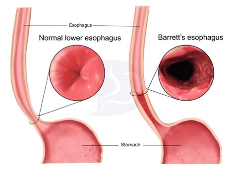 Barrett’s Esophagus: causes and treatment - Digestive and Liver Health ...