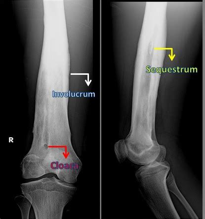 Involucrum | Radiology Reference Article | Radiopaedia.org