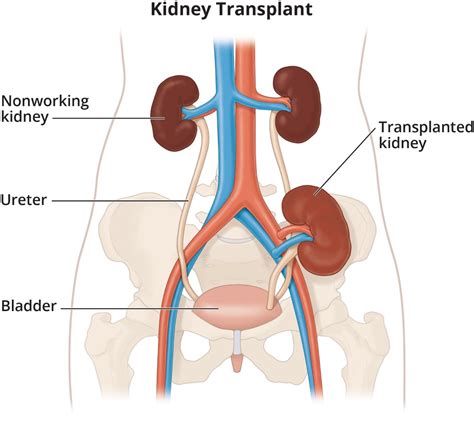 Kidney Transplant - NIDDK