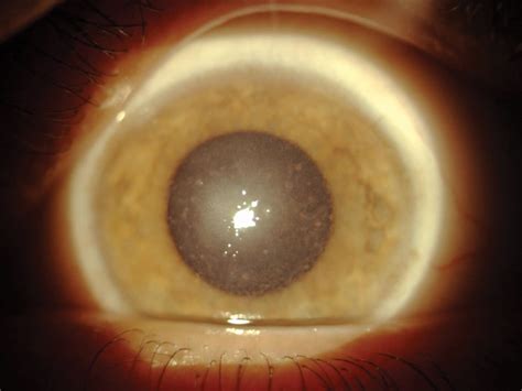 Corneal Dystrophy Congenital Stromal Hereditary Ocular Diseases | Hot ...