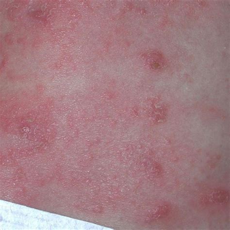 Scabies Rash