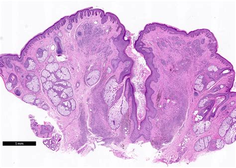 Compound Nevus Histology