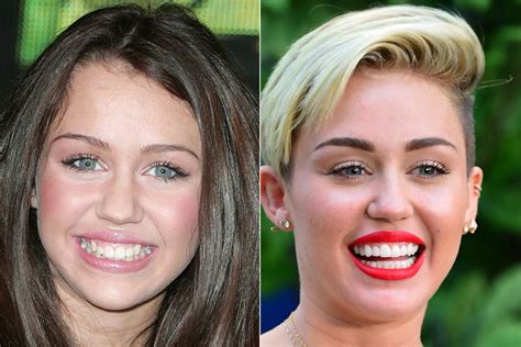 Miley Cyrus Braces And Teeth Transformation