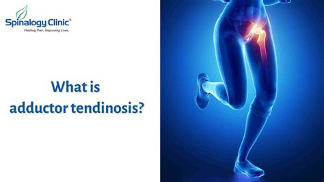 Understanding Adductor Tendinosis: Causes, Symptoms, and Treatment ...