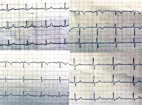 Figure 5 from Wellens’ Syndrome: Focus on Diagnosis and Choice of ...