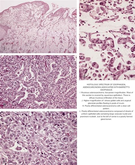 Pathology Outlines - Barrett esophagus (BE)