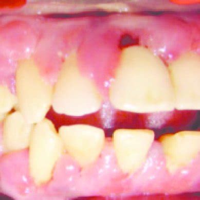 (PDF) Amlodipine-induced Gingival Enlargement