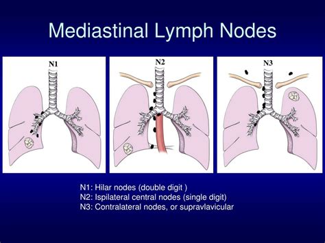 Hilar Lymph Nodes Lung Cancer