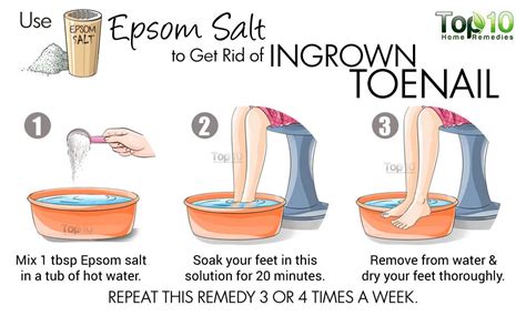 How To Treat Ingrown Toenail At Home Without Effort - Fitneass