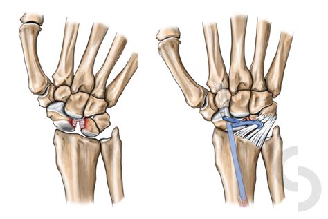 Wrist Ligament Injuries | dr Sonja Cerovac