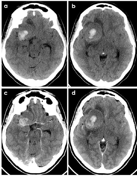 Table 1 from The Hemorrhagic Side of Primary Angiitis of the Central ...