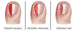 Ingrown Toenail Surgery Hobart | A Cure for Ingrown Toenails, Call Today