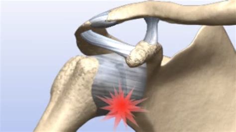 Arthroscopic Repair Of SLAP Tear - Dr. Rahul Bade