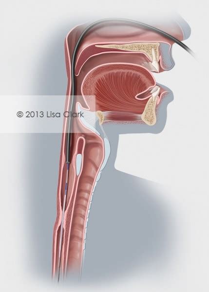 Esophageal Stricture | Clark Medical Illustration