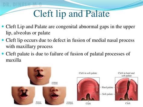 Cleft lip and palate