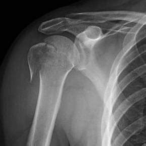 Proximal Humerus Fractures : 네이버 블로그