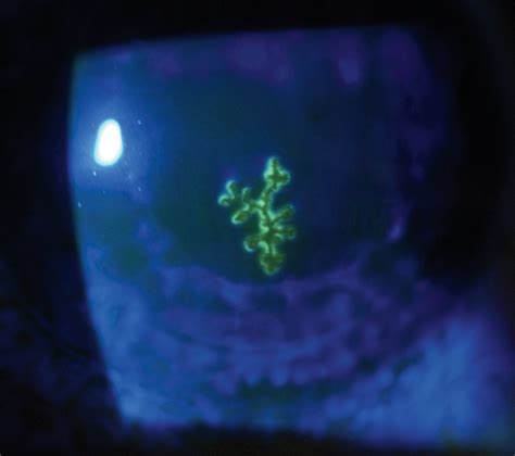 Herpes simplex dendritic ulcer. Fluorescein staining of the cornea that ...