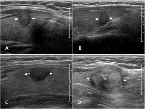 Malignant Thyroid Nodules Ultrasound