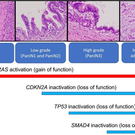 Progression of pancreatic ductal adenocarcinoma development from ...