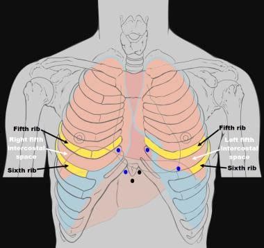 Pericardiocentesis: Overview, Indications, Contraindications