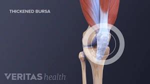 Causes of Knee Bursitis (Prepatellar Bursitis) | Arthritis-health