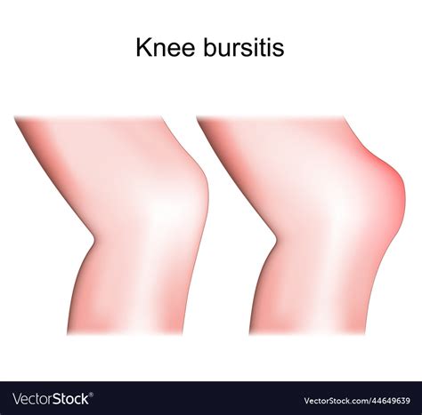 Knee bursitis prepatellar bursitis Royalty Free Vector Image