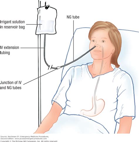 “Gotta Go Right Now”: Use of Whole Bowel Irrigation in the Treatment of ...