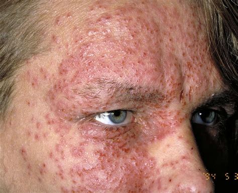 Eczema (Atopic Dermatitis): Overview and More