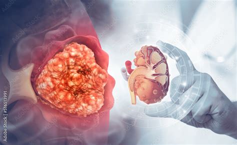 Diagram showing different stages of kidney cancer.3d illustration Stock ...