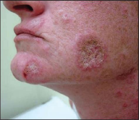 Chronic cutaneous lupus erythematosus. Discoid lupus erythematosus ...