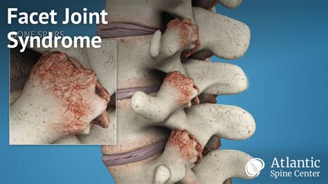 Facet Joint Syndrome - Carolina Regional Orthopedics