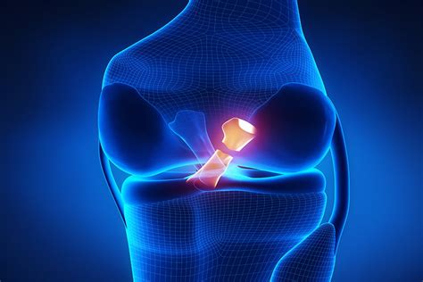 Torn meniscus - diagnosis and treatments at the Zehr Center