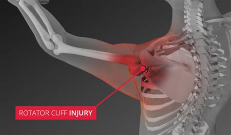 Rotator Cuff Injury Types