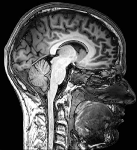 mri scan normal brain sagital view - Neuroscience News