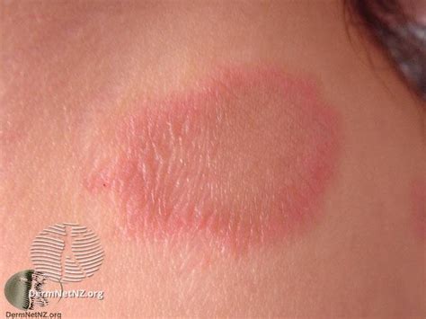 Red Scaly Rash Heres Why You Need A Dermatologist To Diagnose You