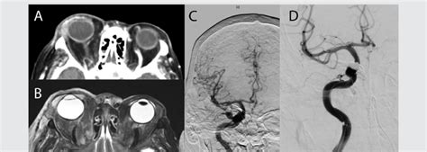 (A) CT Head w/ contrast on HD1, (B) MRI Head w/wo contrast HD14 prior ...