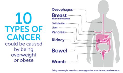 Obesity increases pancreatic cancer risk | Pancreatic Cancer Awareness ...