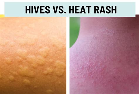 Hives (Urticaria) vs. Rash: Pictures and Differences