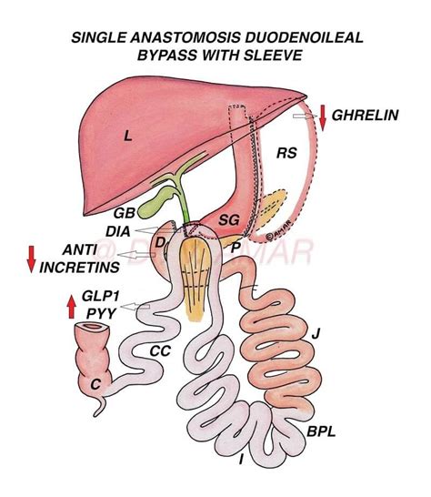 Duodenal Switch – ADVANCED SURGICAL SANTA BARBARA