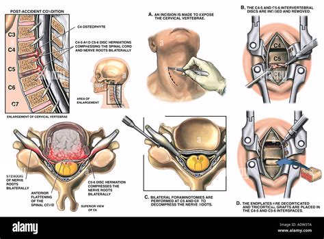 Spine Injury C Cervical Discectomy And Spinal Fusion Surgery | Hot Sex ...