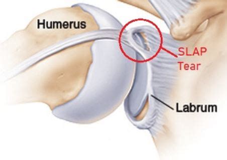 Labral Tear – Dr. Edward Weldon