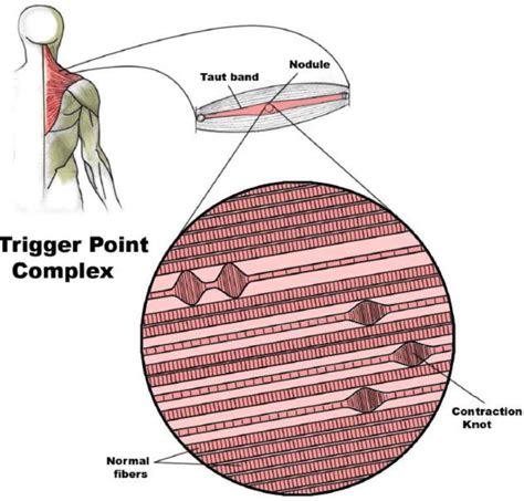 What Are the "Knots" in Muscle? - Northwest Rehabilitation