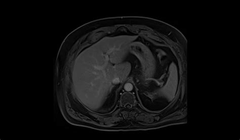 Compressed Sensing (CS) MRI