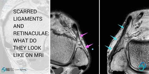 Medial Ankle Ligaments Mri