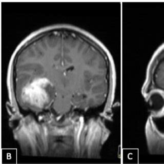 Pre-operative MRI Brain with gadolinium contrast in T1WI (A) axial, (B ...