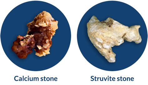 Cystine Kidney Stones