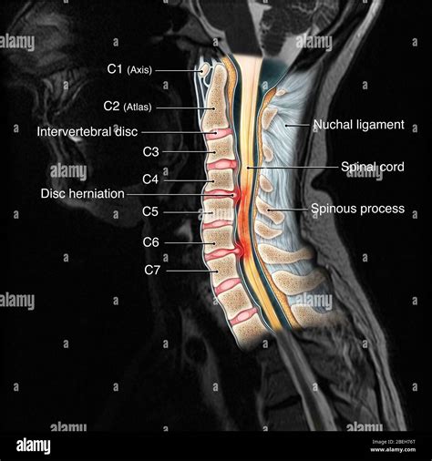 Mri of the cervical spine -Fotos und -Bildmaterial in hoher Auflösung ...