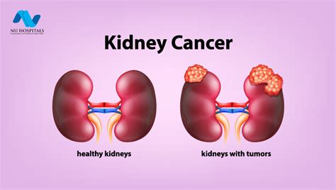 Kidney Cancer: Symptoms, Causes, Diagnosis, and Treatment Options