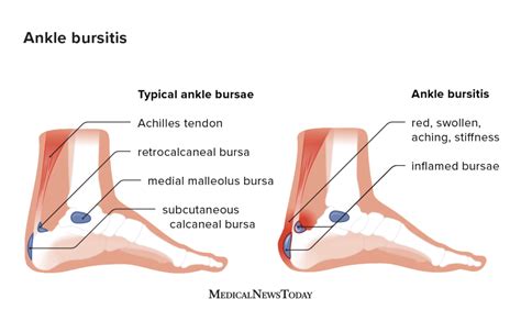 Ankle bursitis: Symptoms, causes, and treatment